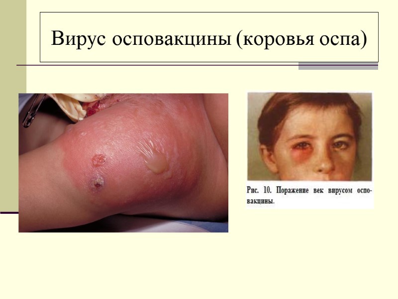 Вирус осповакцины (коровья оспа)